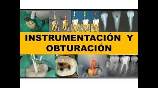 quotINSTRUMENTACION Y OBTURACIÓNquot por el Dr Nestor Jaime [upl. by Nnylrahc500]