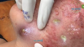 Blackheads amp Acne Treatment Latest Update 09 [upl. by Edobalo]