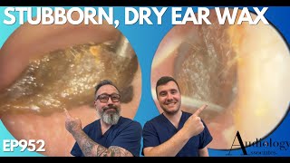 SUPER STUBBORN DRY EAR WAX REMOVAL  EP952 [upl. by Idola539]