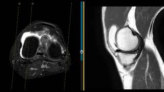 Pain in knee after meniscus tear and ACL sprain [upl. by Ffoeg]