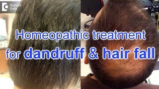 Homeopathic treatment for dandruff and hair fall  Dr Surekha Tiwari [upl. by Millan]