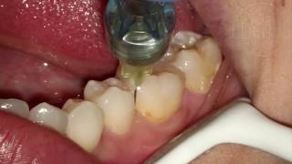 Endodontia de Molar Inferior [upl. by Ollopa]