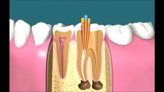 Endodoncia paso a paso  Parte 3 [upl. by Charity]