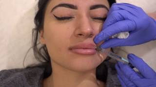 Restylane Defyne Lip Augmentation as a 2nd Syringe [upl. by Bebe]