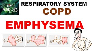 Chronic Obstructive Pulmonary Disease Part 1 Emphysema Pathology [upl. by Atnovart]