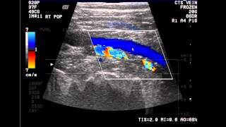 Introduction to the Lower Extremity Venous Doppler Study [upl. by Lerej741]