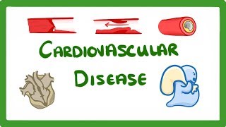 GCSE Biology  Why Do We Get Heart Disease and How to Treat It  Cardiovascular Disease CVD 47 [upl. by Whallon]