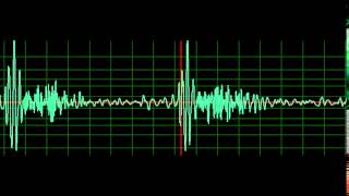 Mitral Regurgitation normal speed [upl. by Sucramraj]