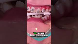 What is Phase 1 in orthodontic treatment  Tooth Time Family Dentistry New Braunfels [upl. by Creighton617]