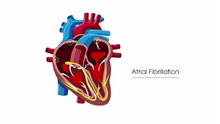 What is atrial fibrillation [upl. by Hilaria614]