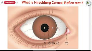 Phoria vs tropia  types of squint  Hirschberg Corneal Reflex Test HCRT  Squint series [upl. by Aeki]