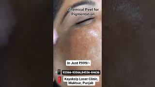 Chemical Peel for Pigmentation [upl. by Inaniel]