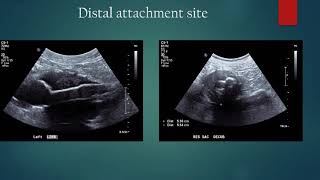 Performing Ultrasound Evaluations on Aorta Endografts EVAR [upl. by Onitnelav292]