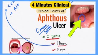 Aphthous Ulcer Explained Like Water  Symptoms Pathophysiology Treatment  Bengali Medicine Lecture [upl. by Lemuela824]