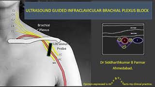 UltrasoundGuided Continuous Interscalene Brachial Plexus Block  Regional Anesthesia [upl. by Ilil]