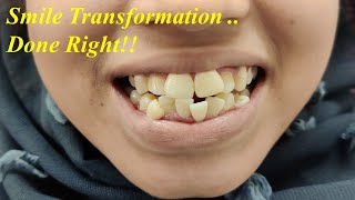 Severe Crowding Braces Treatment Before amp After Orthodontic Rx Smile Transformation  Dr Ram MDS [upl. by Ardaid]