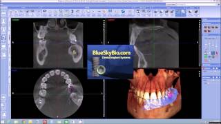 Quick launch 3D volume with impression scans from Planmeca Romexis® to Blue Sky Plan software [upl. by Robers]