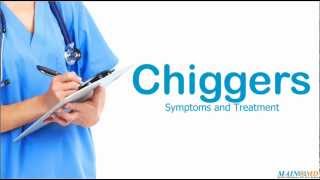 Chiggers Symptoms and Treatment [upl. by Dasteel]