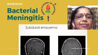 Bacterial Meningitis IAP Thiruvananthapuram Pediatric Webinar [upl. by Lashondra211]