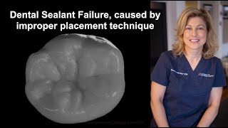 Dental Sealant Failure caused by improper placement technique [upl. by Upshaw]