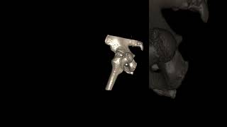 Posterior hip dislocation Posterior acetabular wall fracture pelvis virlashort [upl. by Adyaj531]