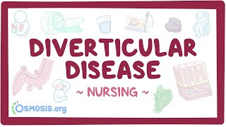 Diverticular disease Clinical Nursing Care [upl. by Beata]