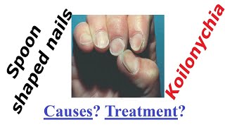 Spoon shaped nails koilonychia causes treatment [upl. by Sekofski]