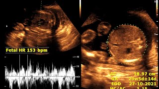 About 23 weeks 3 days pregnancy  Practical case  Ultrasonography finding [upl. by Navoj]