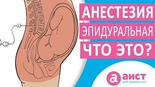 Как делается эпидуральная анестезия при родах [upl. by Nnaeirb340]