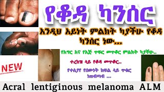 Acral lentiginous melanoma ALM  የቆዳ ካንሰር  የጤና ቃል [upl. by Frants]