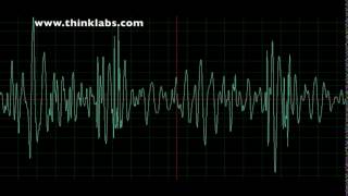 Atrial Septal Defect [upl. by Ailedo]