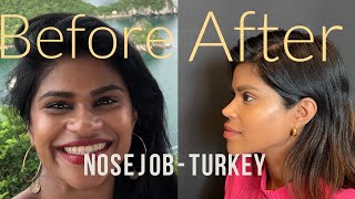 Rhinoplasty in Istanbul Turkey  Dr Umit Taskin [upl. by Ahsya]