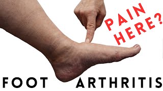 Foot Arthritis Pain Most Common Signs and Symptoms [upl. by Nnylimaj]