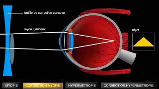 Troubles de la vision myopie et hypermétropie [upl. by Animehliw]