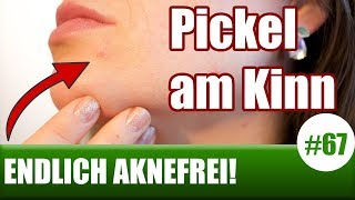 Pickel am Kinn loswerdenHormonelle Hautprobleme  FacemappingGesichtskarte ENDLICH AKNEFREI 67 [upl. by Eniowtna]