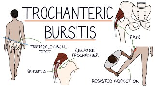 Understanding Trochanteric Bursitis [upl. by Persons]