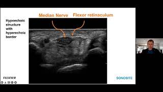 Webinar Ultrasoundguided Peripheral Nerve Hydrodissection [upl. by Aylward]