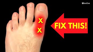 How to Fix BIG TOE Pain for Good [upl. by Sturdivant]