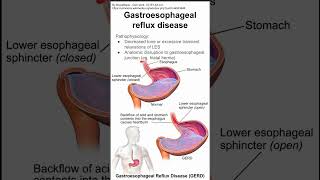 Gastroesophageal reflux disease GERD [upl. by Murielle]