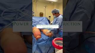 Lipedema Surgery  Liposuction for Lipedema Before amp After  Dr Boris Volshteyn [upl. by Tayyebeb]