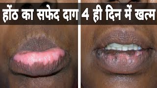 होंठ का सफेद दाग ठीक करे बस 4 ही दिन में  hoth pe safed daag ka ilaj  vitiligo on lips [upl. by Fanestil]