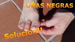 UÑAS NEGRAS como provocar el sangrado para aliviar la presión que impide correr [upl. by Dierolf]