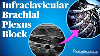 Ultrasoundguided infraclavicular brachial plexus block [upl. by Shela806]