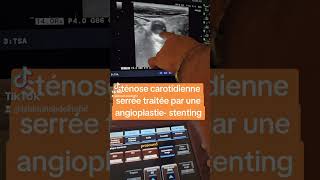 sténose carotidienne serrée traitée par une angioplastie stenting [upl. by Nytsirhc]