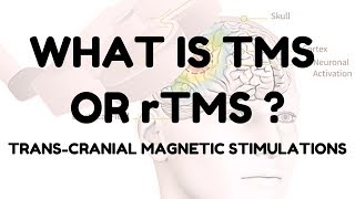 rTMS  Repeated Transcranial Magnetic Stimulation [upl. by Vevay252]