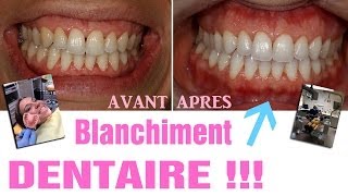 Blanchiment dentaire  AVANTAPRES Revue 25 [upl. by Otinauj92]