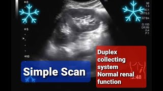 Duplex collecting system of Kidney l congenital kidney malformation l [upl. by Ijok41]