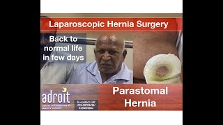 Laparoscopic surgery for Parastomal hernia Patient review [upl. by Alios]