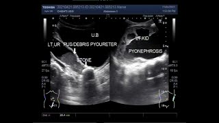 Pyonephrosis associated with pyoureter and a large ureteric stone [upl. by Annaitsirk100]