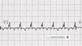 ECG Features of Hyperkalemia [upl. by Cyd]